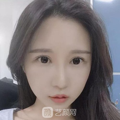 成都銅雀臺雷剛雙眼皮修復案例分享，半個月果圖~